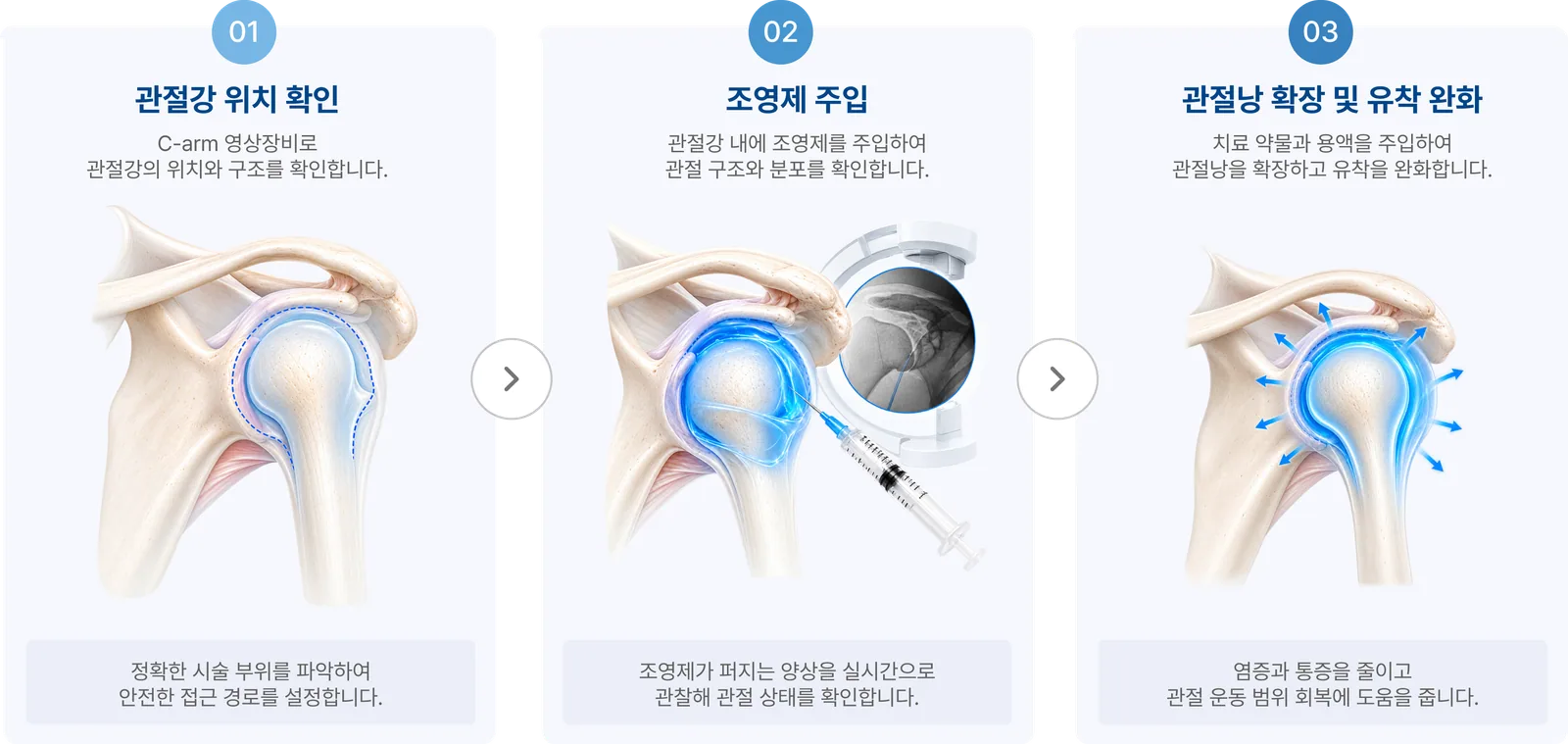시술 과정 3단계: 01 관절강 위치 확인, 02 조영제 주입, 03 관절낭 확장 및 유착 완화