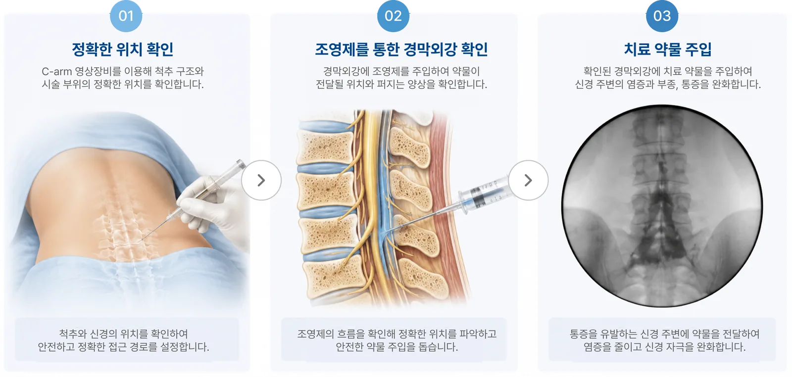 시술 과정 3단계: 01 정확한 위치 확인, 02 조영제를 통한 경막외강 확인, 03 치료 약물 주입